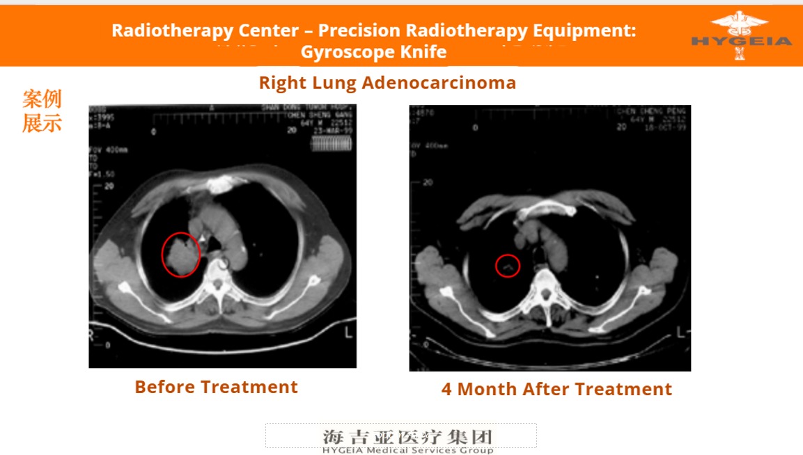 Patient testimonial 2